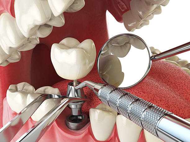 Best Broken or Chipped Tooth Repair in Wheeling, WV